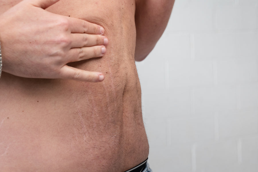 Hands on looser skin on a man's stomach