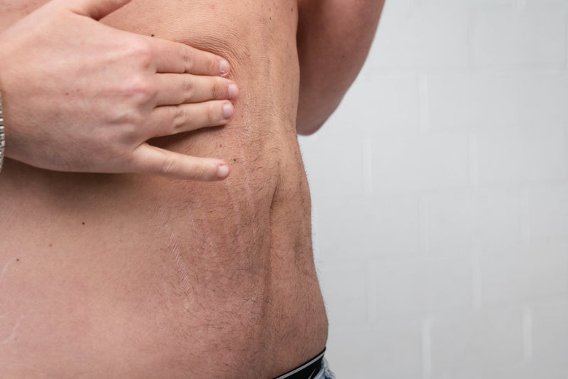 HOW TO FIRM SKIN AFTER WEIGHT LOSS ON GLP-1: WHAT ACTUALLY WORKS - ElastiK° Skin