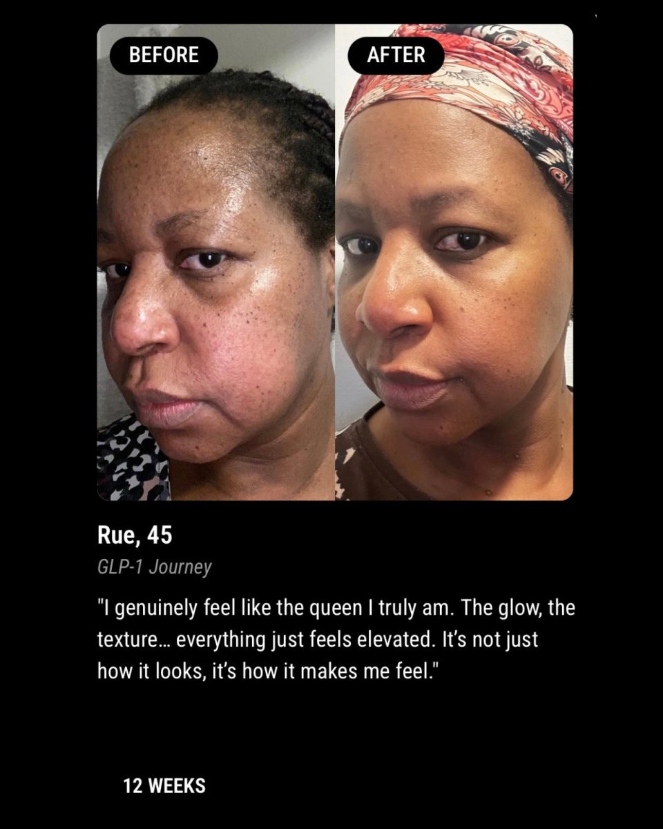RESILIENCE MATRIX NIGHT CREAM | For GLP - 1, Weight Loss, Ageing & Postpartum Skin - ElastiK° Skin