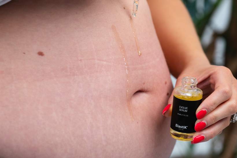 Evolve Serum being applied to a postpartum tummy with stretch marks